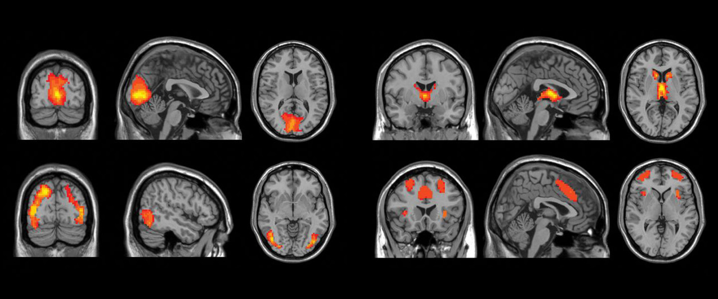 Large Machine-Learning Study Searches for Diagnostic Biomarkers in Major Depressive Disorder
Large Machine-Learning Study Searches for Diagnostic Biomarkers in Major Depressive Disorder