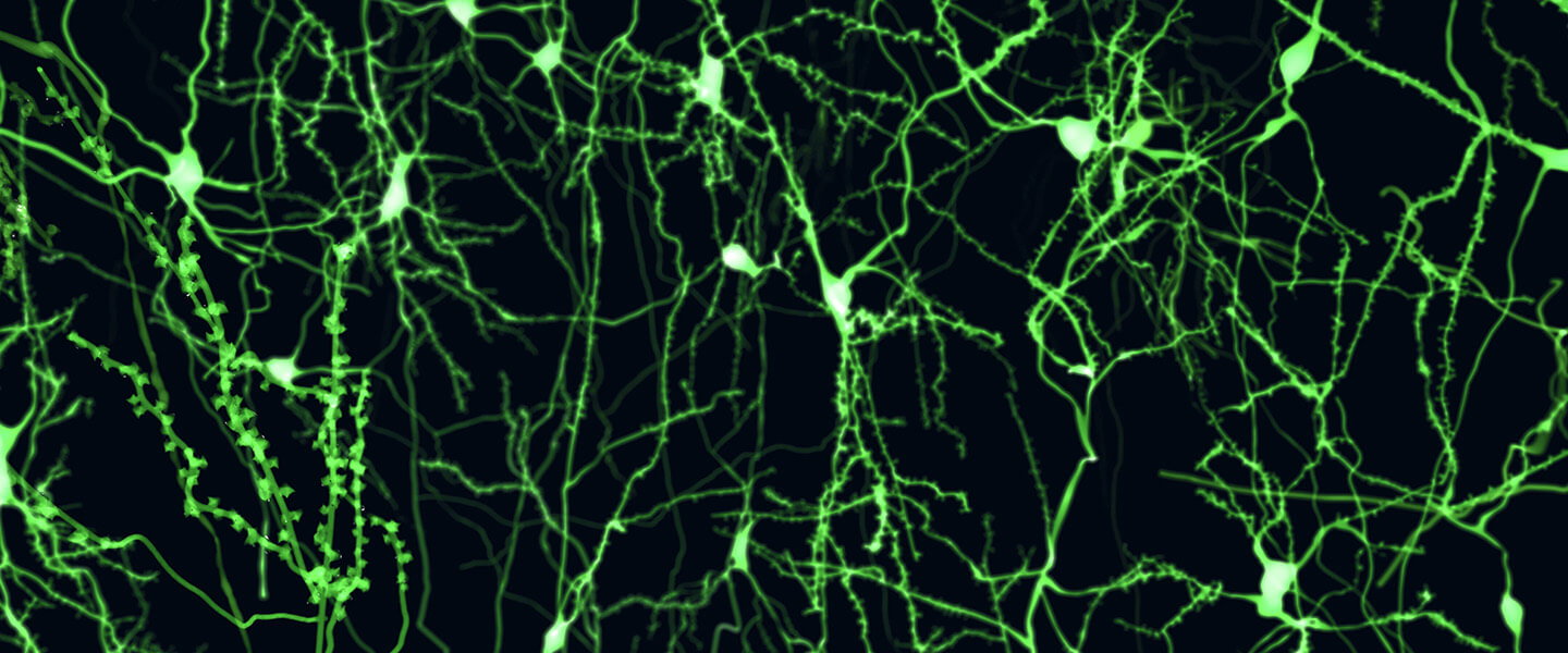 Functional Connectivity Brain Changes Involving Linkages Between Cognition and Motor Function Are Discerned in OCD Patients
