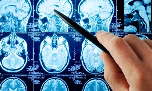 Unique Neural Activation Pattern in People With Co-Occurring Bipolar Disorder and Alcohol Use Disorder Points to Future Treatment Targets Unique Neural Activation Pattern in People With Co-Occurring Bipolar Disorder and Alcohol Use Disorder Points to Future Treatment Targets