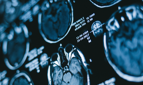 A Way of Predicting if New Psychosis Patients Will or Won’t Respond to Standard Treatment A Way of Predicting if New Psychosis Patients Will or Won’t Respond to Standard Treatment