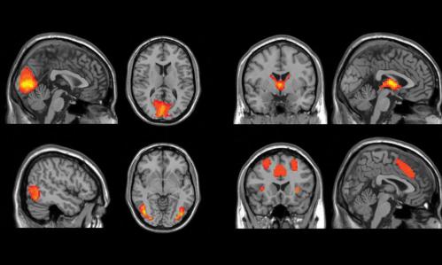 Large Machine-Learning Study Searches for Diagnostic Biomarkers in Major Depressive Disorder Large Machine-Learning Study Searches for Diagnostic Biomarkers in Major Depressive Disorder