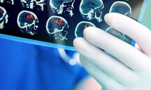 Brain Scans Reveal a Possible Biomarker for Suicidal Thoughts in PTSD Brain Scans Reveal a Possible Biomarker for Suicidal Thoughts in PTSD