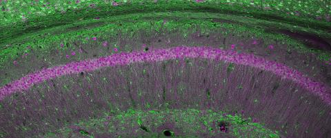 Variations in Schizophrenia-Linked Gene Are Linked With Pathology in Prefrontal Cortex, Impairing Cognition Variations in Schizophrenia-Linked Gene Are Linked With Pathology in Prefrontal Cortex, Impairing Cognition