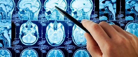 Unique Neural Activation Pattern in People With Co-Occurring Bipolar Disorder and Alcohol Use Disorder Points to Future Treatment Targets Unique Neural Activation Pattern in People With Co-Occurring Bipolar Disorder and Alcohol Use Disorder Points to Future Treatment Targets