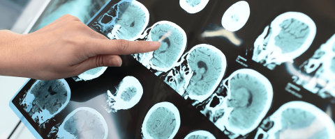 Deep-Brain Stimulation Showed Multi-Year Effectiveness in Severely Depressed, Treatment-Resistant Patients Deep-Brain Stimulation Showed Multi-Year Effectiveness in Severely Depressed, Treatment-Resistant Patients