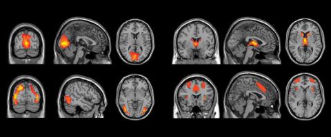 Large Machine-Learning Study Searches for Diagnostic Biomarkers in Major Depressive Disorder Large Machine-Learning Study Searches for Diagnostic Biomarkers in Major Depressive Disorder