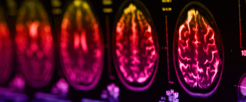 Imaging Study Links Changes in Function and Structure of the Hippocampus in Early Psychosis